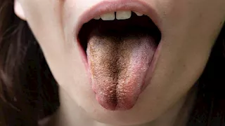 لون لسانك قد يكشف حالتك الصحية.. متى يصبح الأمر خطيرًا؟