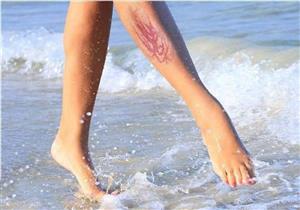  لدغة قنديل البحر.. الأسباب والعلاج ومتى يحب استشارة الطبيب