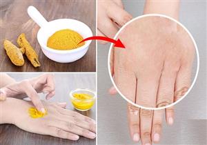 فوائد الكركم للبشرة.. هل يساعد على علاج الإكزيما؟