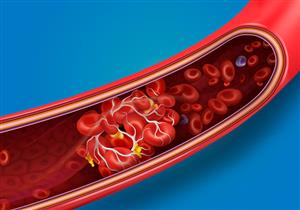  "يظهران في المرحاض".. عرضان يشيران إلى إصابتك بجلطة دموية مميتة 