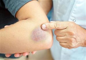  لغز الكدمات الزرقاء في الجسم.. ما أسبابها؟  