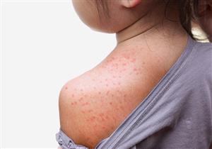 يعاني طفلِك من حمو النيل؟.. اتبعي هذه النصائح لعلاجه