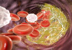  "القاتل الصامت".. علامة تحذير كريهة الرائحة تنذر بارتفاع الكوليسترول