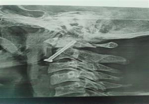 صور.. جراحة دقيقة بالعمود الفقري تنقذ حياة شاب في مستشفى جامعة سوهاج