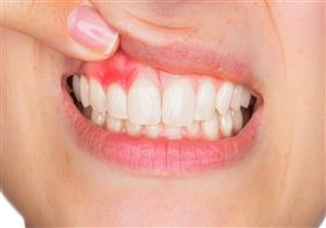 تصل إلى تلف القلب والدماغ.. تعرف على أخطر مضاعفات ألم اللثة