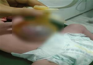 بنها التخصصي ينقذ حياة طفل ولد بأمعاء خارج البطن 