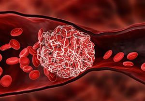 الشعور بهذا الألم يشير إلى إصابتك بجلطة دموية خطيرة