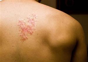 الجرعة بـ4338 جنيهًا.. توفير لقاح "الحزام الناري" بالمصل واللقاح وهذه الفئات المستهدفة