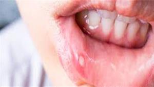 الصحة العالمية: أمراض الفم تصيب 3.5 مليارات شخص