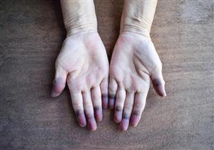 تظهر على اليد.. 4 علامات غريبة تشير إلى إصابتك بـ"قاتل صامت"