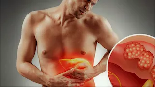 جرعتان فقط.. علاج واعد لسرطان الكبد لدى طفل