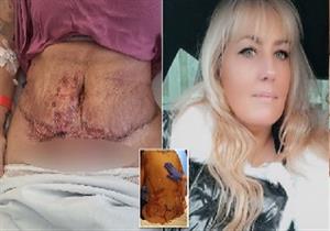 بسبب عملية شد البطن- إصابة سيدة بعدوى قاتلة