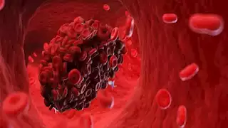 علامات مبكرة وتحذيرات من جلطات الدم.. تعرف عليها قبل أن تُهدد صحتك