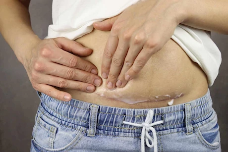 بعد الولادة القيصرية..5 نصائح ضرورية للتعافي