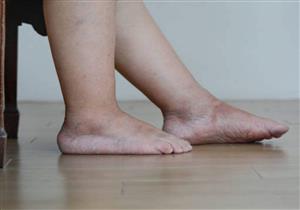 تورم قدميك تشير إلى حالة صحية تتطلب استشارة الطبيب فورا