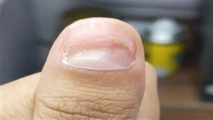 سيدة تنشر صورا لأظافرها المتآكلة.. والسبب غير متوقع