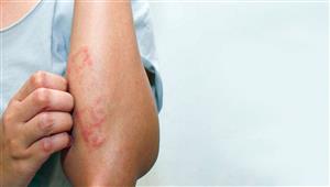 بشرى سارة للعالم.. علاج جديد يحقق نتائج مبهرة ضد سرطان الدم