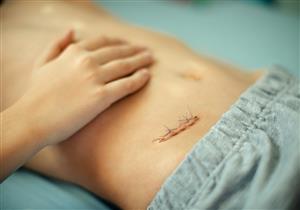 عملية اسئتصال الزائدة الدودية- دليل شامل بأهم المعلومات