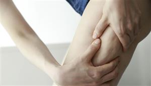 دراسة: السيلوليت قد يحمي النساء من مرض خطير