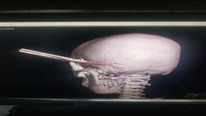 في 4 ساعات.. "الطوارئ الجامعي"يستخرج مبردًا اخترق رأس طفل في الدقهلية (صور)