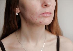 أسباب حب الشباب الهرموني- هل يدل على الحمل؟