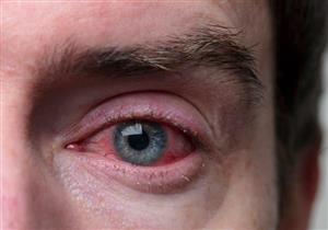 س & ج- دليل شامل عن إنفلونزا العيون