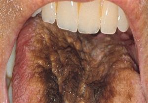 رجل هندي يتحول لسانه للون الأسود المغطى بالشعر.. إليك السبب