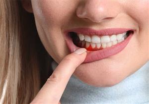 ماذا تفعل لعلاج التهاب اللثة في المنزل؟