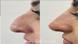 اعوجاج الحاجز الأنفي.. أسباب وأعراض