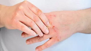 حتى مع النظافة اليومية.. لماذا تظهر الالتهابات الجلدية القيحية؟