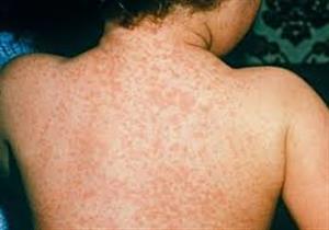 هل يسبب فيروس الحصبة مرضا قاتلا؟