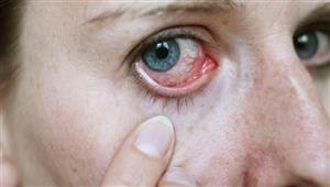  هربس العيون.. إليك الأعراض والعلاج