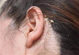  فطريات فروة الرأس.. الأسباب والأعراض 