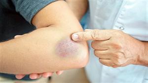 صحتك في رمضان: لغز الكدمات الزرقاء في الجسم.. ما أسبابها؟  