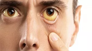 طبيب يكشف أسباب اليرقان ومضاعفاته الصحية