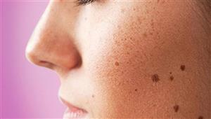  هكذا تواجهين البقع الصبغية