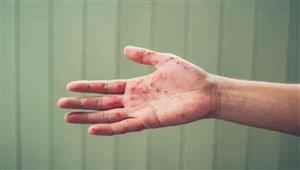   متعافو "جدري البشر".. هل لديهم حصانة ضد فيروس القرود؟