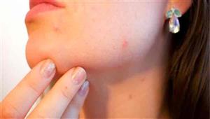 جدري القرود: المغرب يعلن عن 3 حالات يشتبه في إصابتها بالمرض