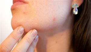 رصد أول إصابة بجدري القردة في الجيش الإسرائيلي