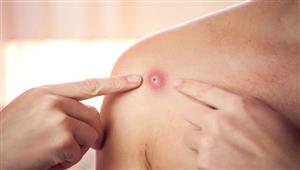 السعودية تعلن رصد أول حالة لجدري القرود بالمملكة