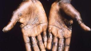 "الصحة العالمية" تحذر من تفش أوسع لجدري القرود بسبب المهرجانات والحفلات الصيفية