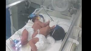 بالفيديو- الحالة الصحية لـ"توأم أسيوط" السيامي.. الطبيب المعالج يكشف التفاصيل