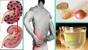 5 مشروبات تفتت حصوات الكلى.. الأبرز عصير الكرفس