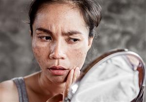 احذرها.. علامات تظهر على جلدك وعينيك تدل على ارتفاع الكوليسترول