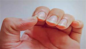 ستتفاجأ.. هذا ما يشير إليه تلك البقع البيضاء على أظافرك 