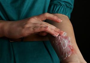 حروق الكهرباء- ما هي الإسعافات الأولية لإنقاذ المصاب؟