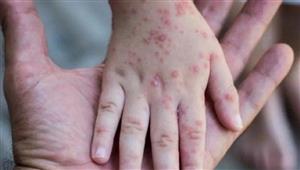 دعوات داخلية في بريطانيا للتحرك لمنع تحول جدري القرود إلى مرض متوطن