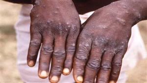 جدري القرود.. تسجيل ثاني وفاة في أوروبا وطوارئ بأمريكا