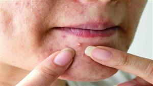 10 أسباب لظهور حبوب الجبهة- طرق طبيعية لعلاجها 