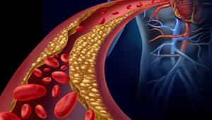 منها عصير الطماطم.. مشروبات تساعد في خفض مستويات الكوليسترول